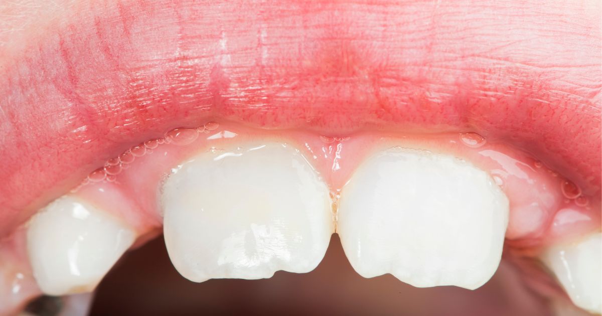 Denti a coniglio nei bambini: cause, rimedi e trattamenti ortodontici