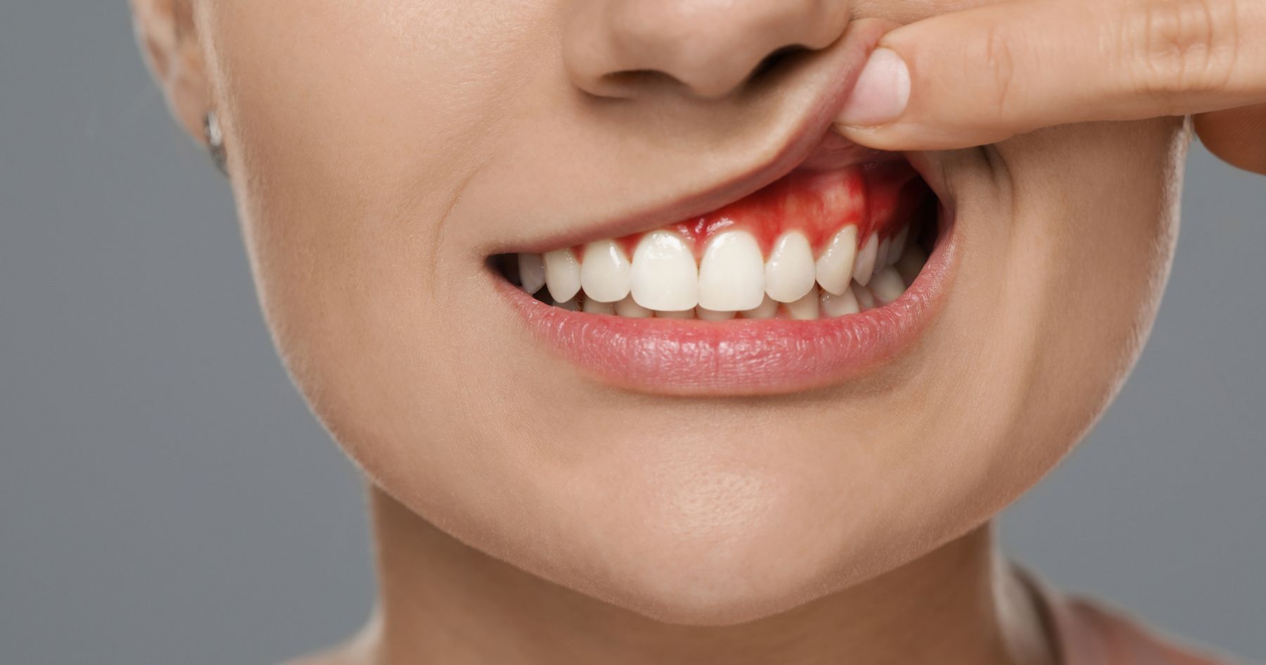 Denti che sanguinano nei bambini e adolescenti