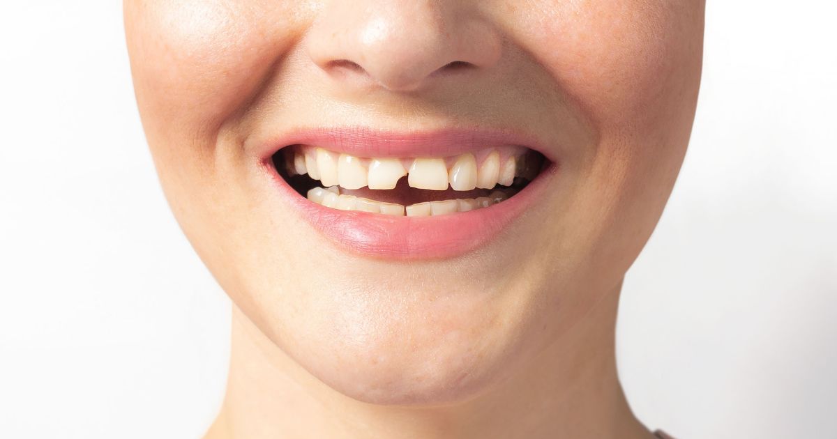 Trauma dentale bambini: cosa fare se tuo figlio cade e batte i denti