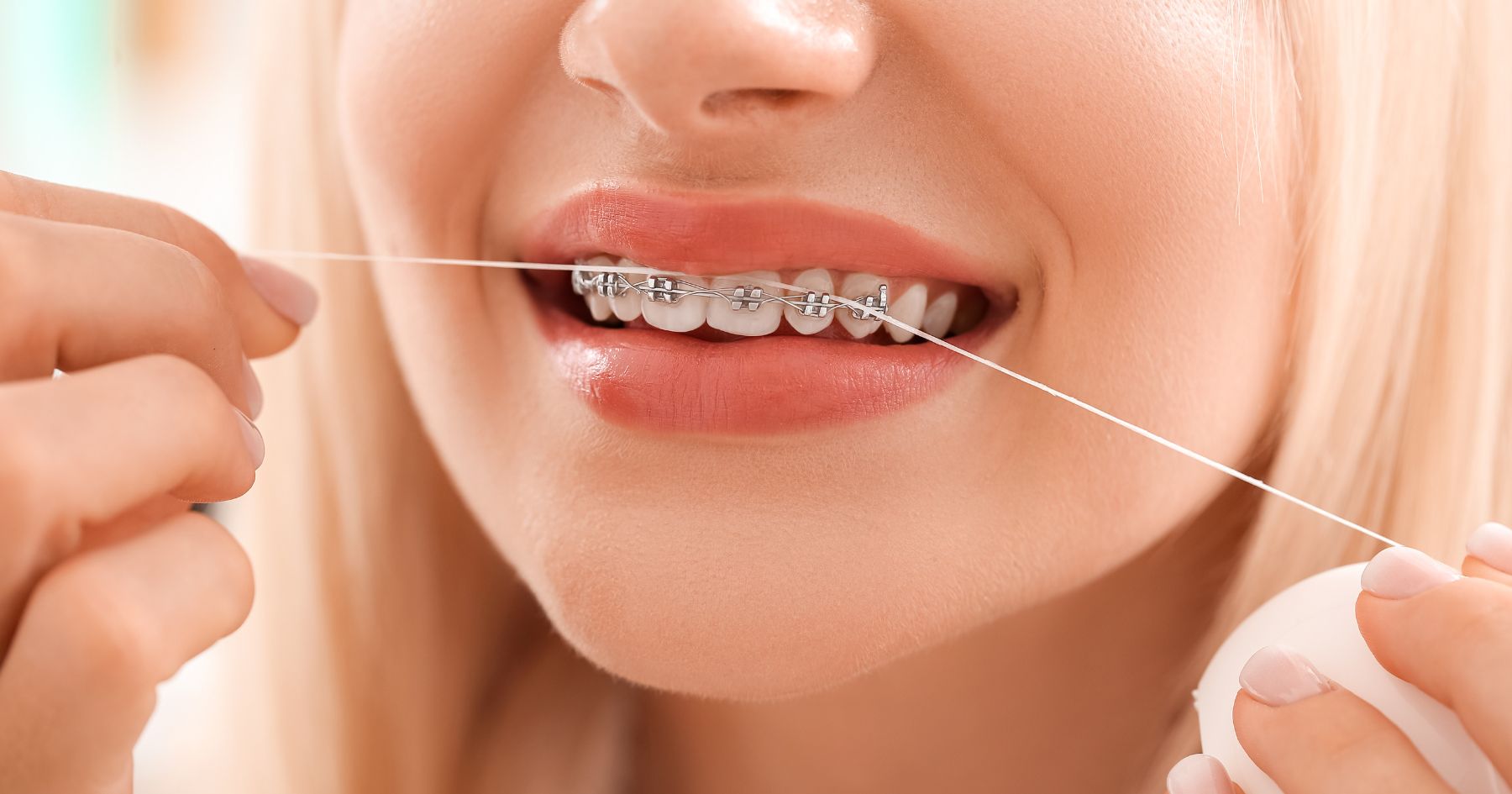 Afte da apparecchio: rimedi pratici, gel utili e come evitare che tornino