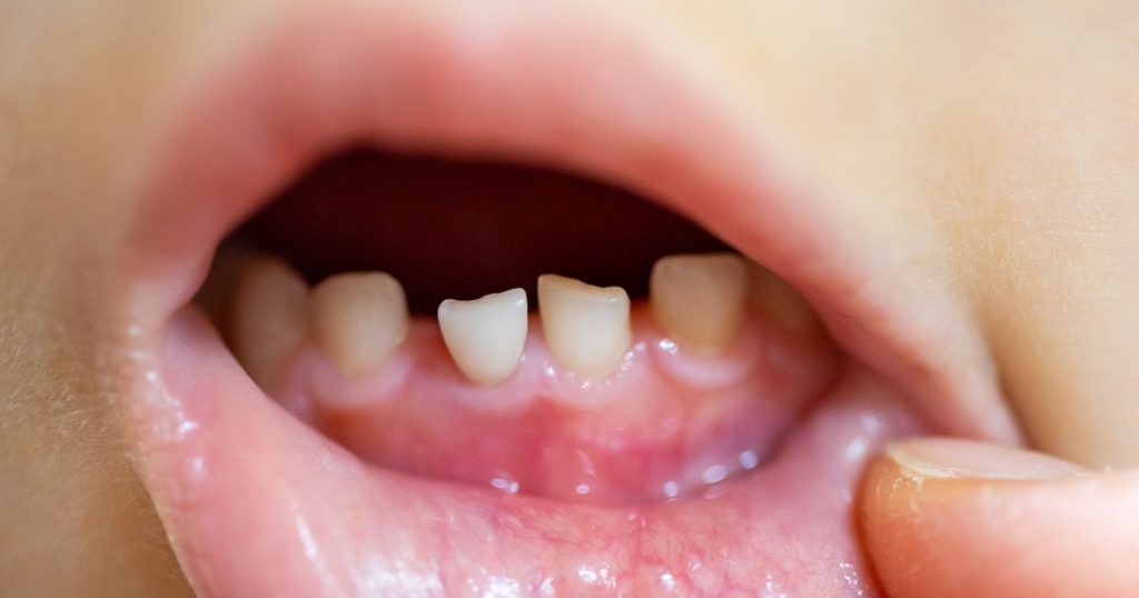 nascita dei denti permanenti nei bambini