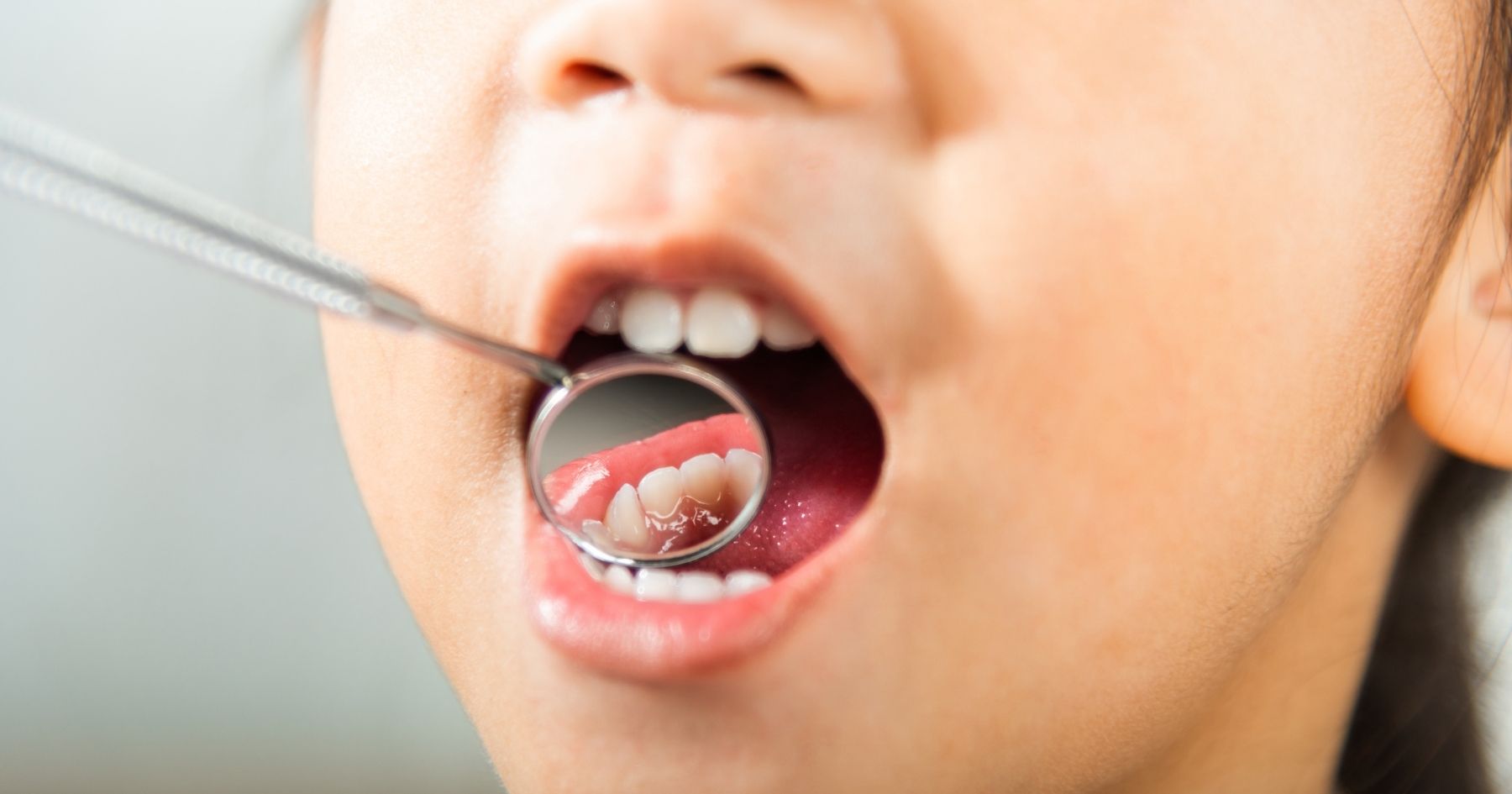 Carie nei denti da latte: bisogna davvero curarle?