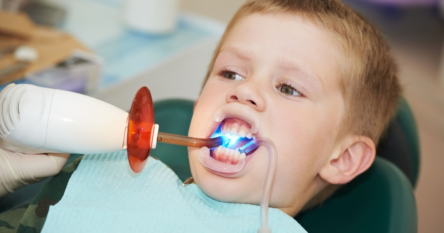 Sigillatura dei molari permanenti nei bambini: quando farla e quanto dura