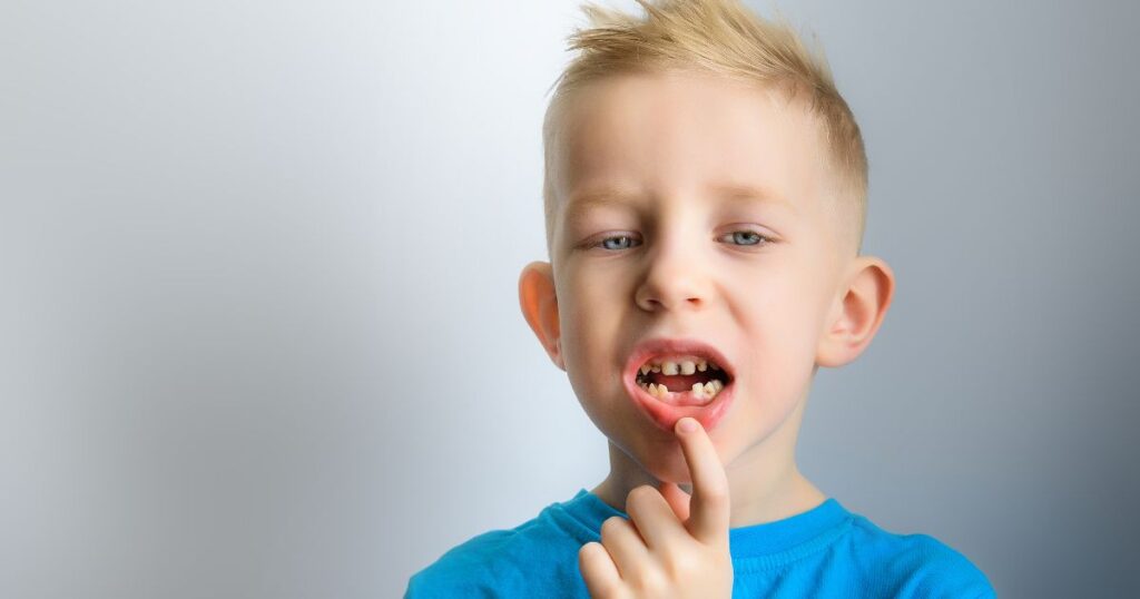 i denti da latte con carie vanno curati, perché portano a una serie di problemi, oltre al dolore fisico